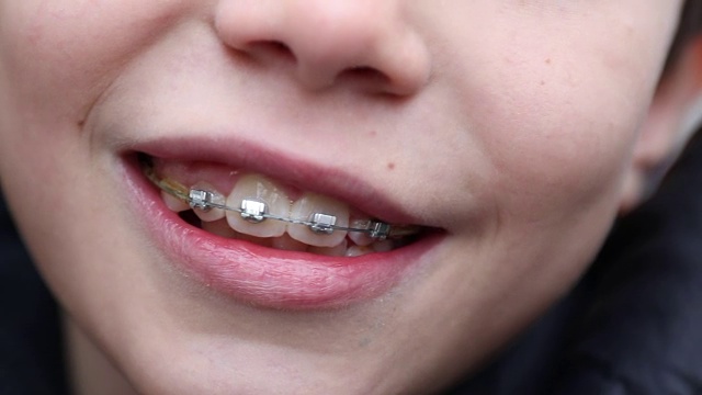 一个在街上用牙科器械的孩子的特写视频下载