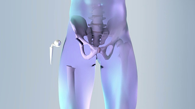 髋关节置换植入物安装在骨盆骨。医学精准3D动画视频素材