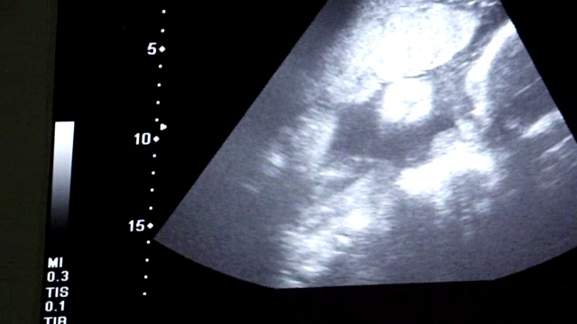 超声波的婴儿视频素材