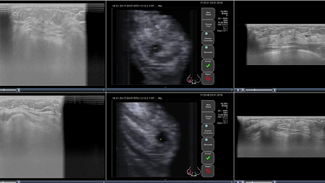 从电脑显示器上的乳房扫描仪上得到报告视频下载