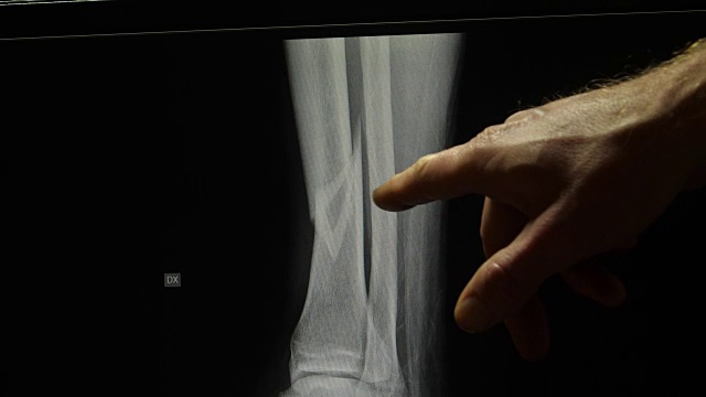骨科医生指骨折的胫骨骨腿x光片视频下载