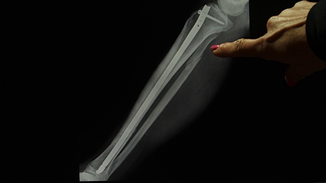 放射科医生用钛棒x光片显示骨折的腿视频素材