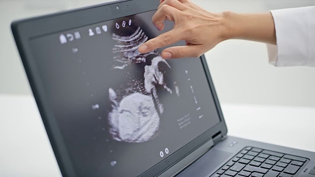 一位女医生和病人的手指着电脑屏幕上的超声波照片视频下载