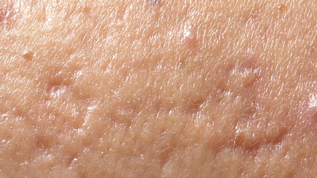 皮肤上的球状囊性痤疮。皮肤科的概念视频素材