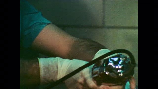 1978年，医生对支气管通道内的肿瘤患者进行治疗视频下载