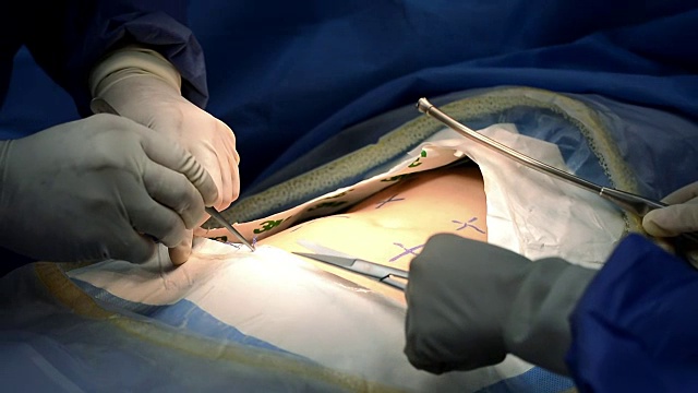 对在手术室手术的外科医生、使用手术设备的外科医生团队和在医院急诊室进行手术的病人进行特写视频下载