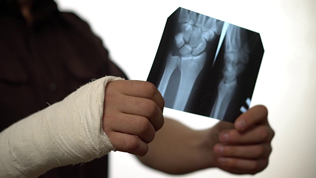 一名右手骨折的男子看着仁根的照片。手骨折导致残疾。健康保险。特写镜头视频素材