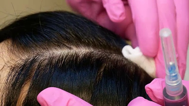 一个漂亮的女人在头部注射之前。这个手术让医生戴上了粉红色的手套。中间疗法的概念。推动以加强头发和它们的生长视频素材