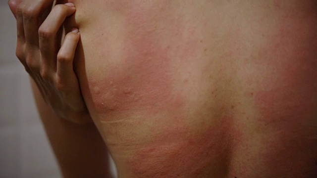 雌性的背部被荨麻疹抓伤。视频素材