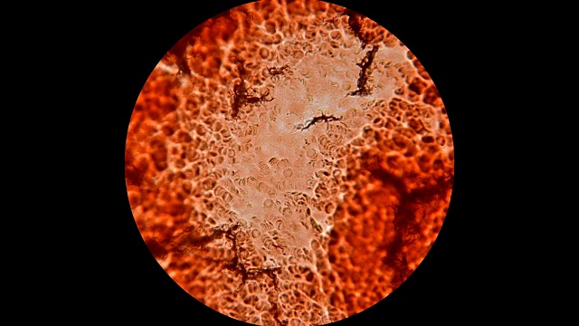 在显微镜下凝固干燥的血液视频素材