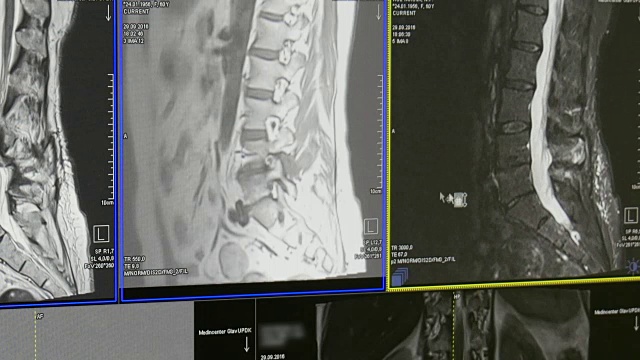 MRI上的脊髓和脊柱断层扫描。视频素材
