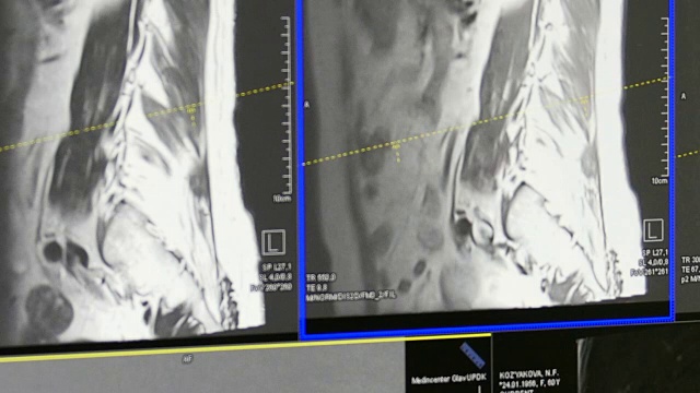 MRI上的脊髓和脊柱断层扫描。视频素材