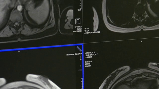 MRI脑部断层扫描专业医疗设备。视频素材
