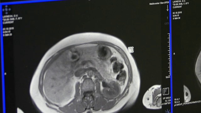 MRI脑部断层扫描。视频素材