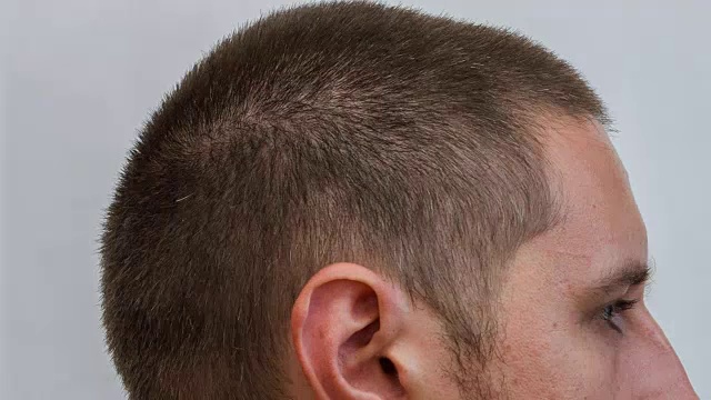 男性头部-年轻白种人头发生长的过程视频素材