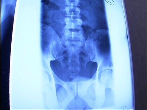 灯箱上的医用x光片。它们是一个人的躯干和脊柱。视频下载