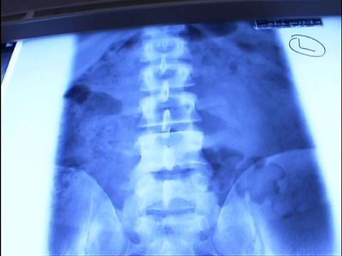 一个人的脊柱灯箱上的医用x射线特写。当镜头向上倾斜时，就会缩小。视频下载
